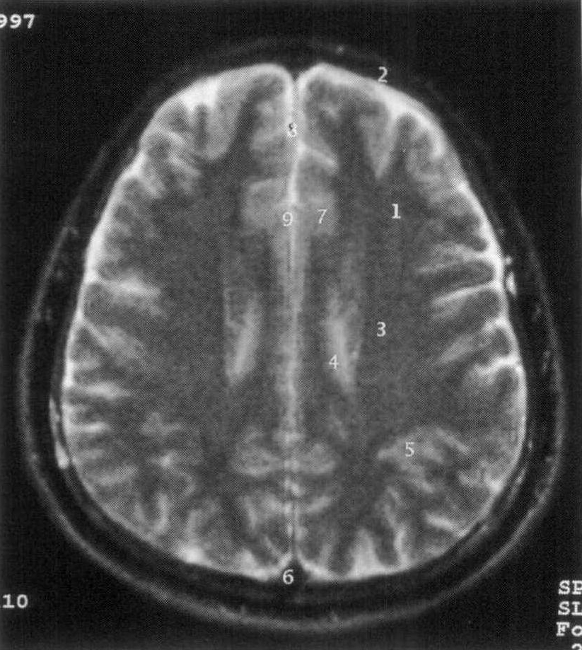 第一节 颅脑MRI基本读片知识
